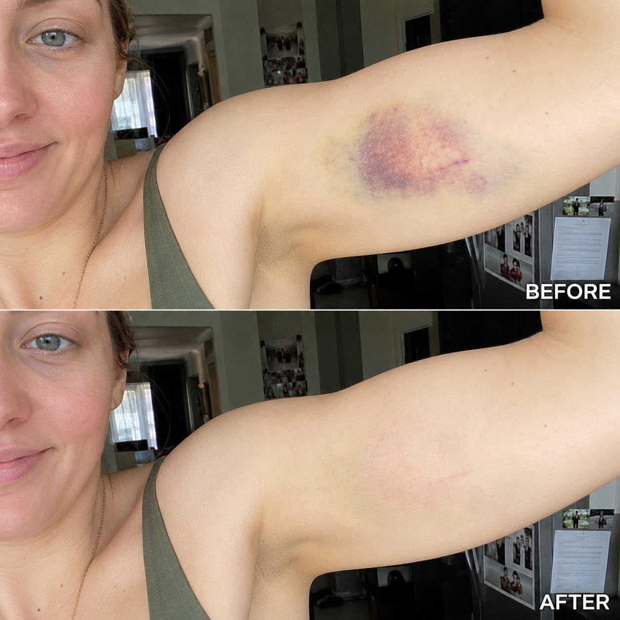 Bruise Fade Pro™ Advanced Bruise Recovery Cream – Arnica & Vitamin K Skin Repair Formula
