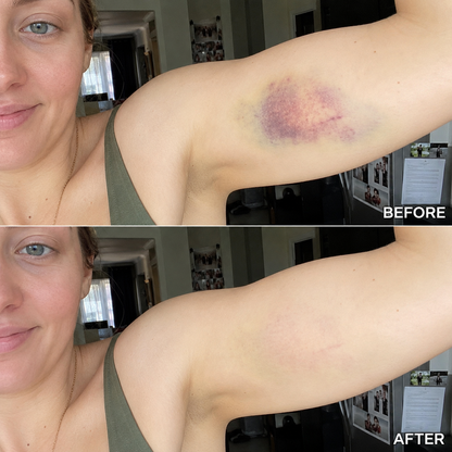 Bruise Fade Pro™ Advanced Bruise Recovery Cream – Arnica & Vitamin K Skin Repair Formula