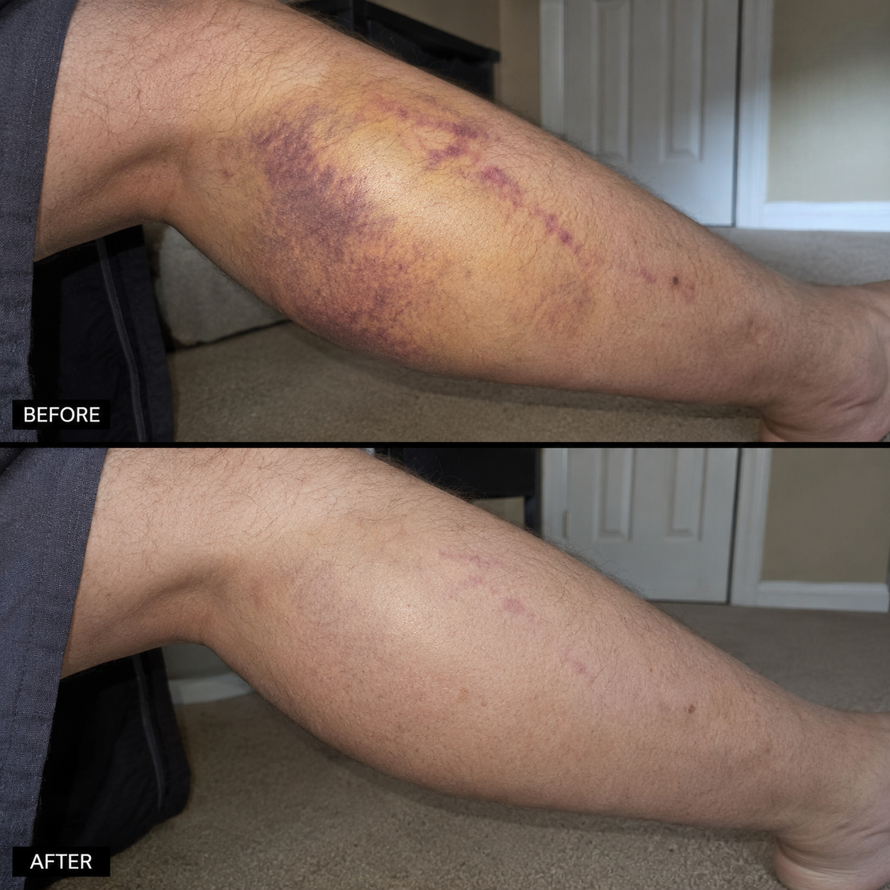 Bruise Fade Pro™ Advanced Bruise Recovery Cream – Arnica & Vitamin K Skin Repair Formula