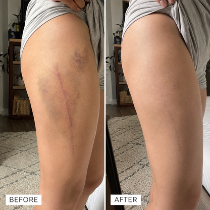 Bruise Fade Pro™ Advanced Bruise Recovery Cream – Arnica & Vitamin K Skin Repair Formula