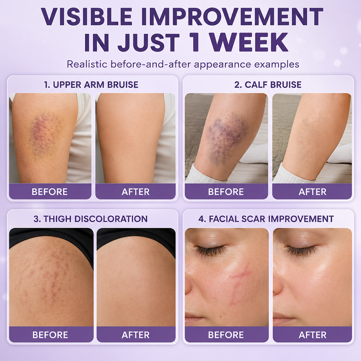 Bruise Fade Pro™ Advanced Bruise Recovery Cream – Arnica & Vitamin K Skin Repair Formula