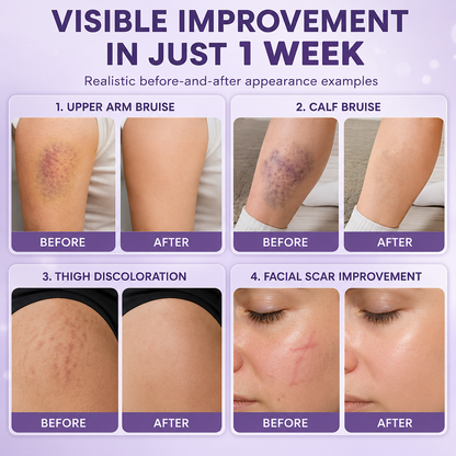 Bruise Fade Pro™ Advanced Bruise Recovery Cream – Arnica & Vitamin K Skin Repair Formula